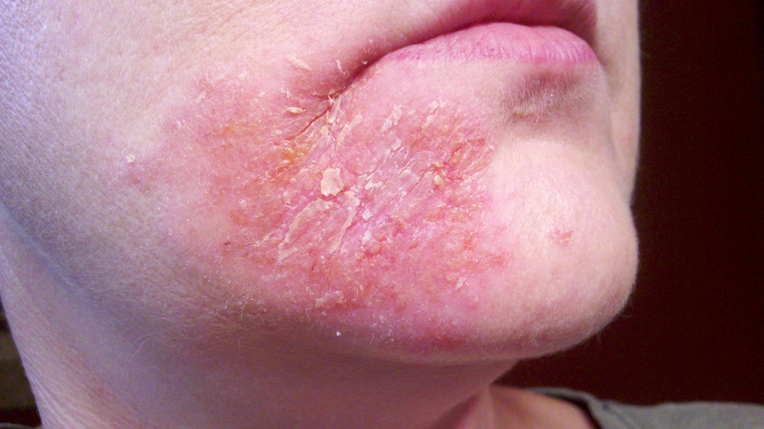 perioral eczema